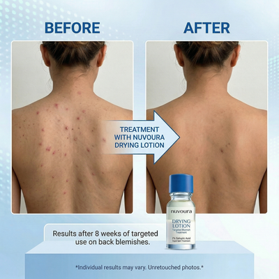 Nuvoura Blemish Drying Lotion